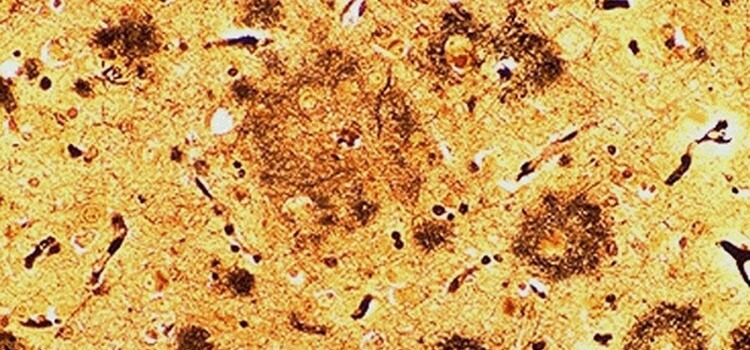 Alzheimer Hastalığından Sorumlu İki Protein : Amiloid ve Tau